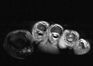 Figure 2 for case Nodular Localized Cutaneous Amyloidosis